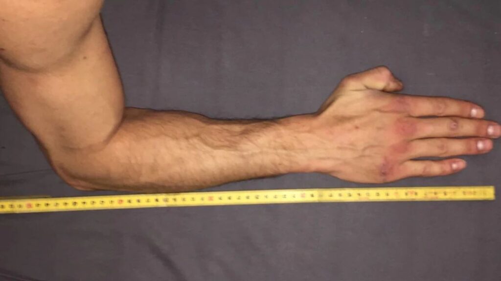 From Elbow to Fingertips